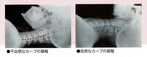 スマホ首｜不自然なカーブの頚椎