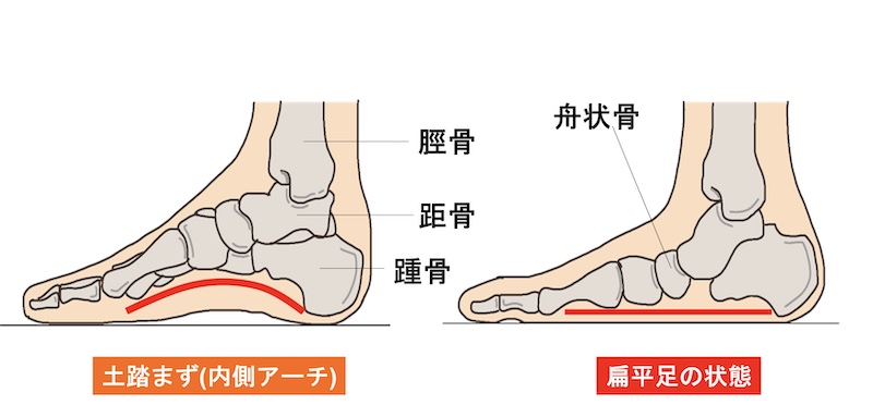 足底腱膜炎（そくていけんまくえん）・足底筋膜炎（そくていきんまくえん）と扁平足
